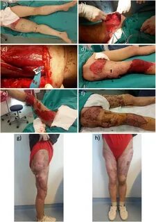Perforator artery repair in revascularization of extremity d