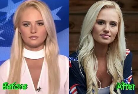 Tomi Lahren Plastic Surgery: Making Headlines For Her Face