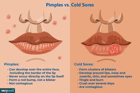 Cold sore on boob