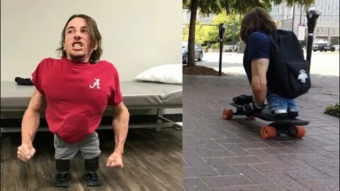 Legless man stands on feet for the first time Boosting nub s