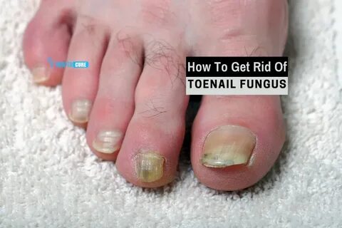 How To Know If Toenail Fungus Is Dying - How To Get Rid Of T