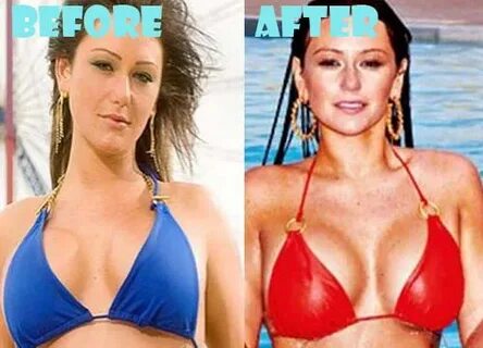 JWoww Plastic Surgery Before and After Facelift, Boob Job an