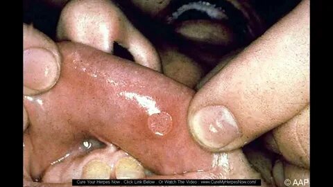 herpes penis shaft - pictures, photos