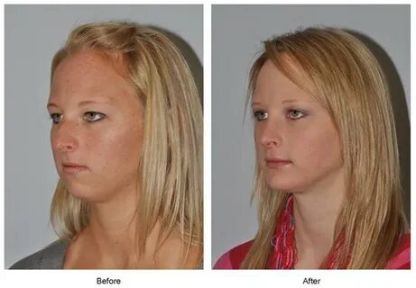 Rhinoplasty: Building a New, More Attractive Nose