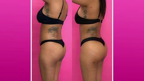 BBL Before and Afters of Skinny BBL Brazilian Butt Lift & Aw