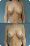Photos of breasts after augmentation - Porn Gallery