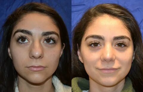 Nose Surgery Before & After Photos Patient 204 San Francisco