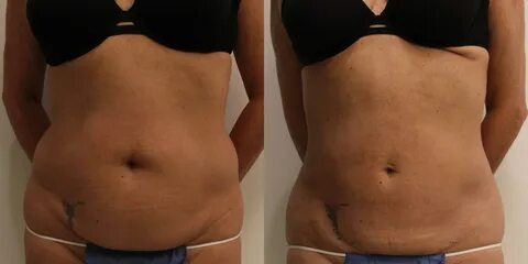 Liposuction Before and After Pictures Case 52 Barrington, Il