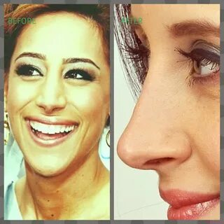 Danielle Jonas Nose Job Photos Before & After - Surgery4