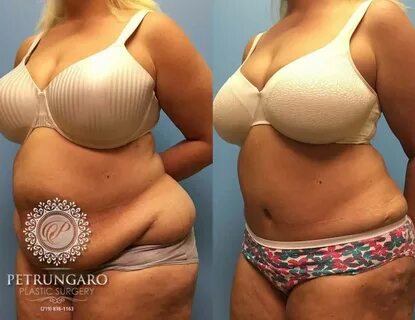 51 F After Tummy Tuck with Lipo 360 Petrungaro Plastic Surge
