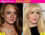 Lindsay-Lohan-Plastic-Surgery-171 - Lindsay Lohan Plastic Su