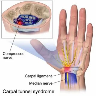 Que Es Carpal Tunnel Syndrome - Quotes Type