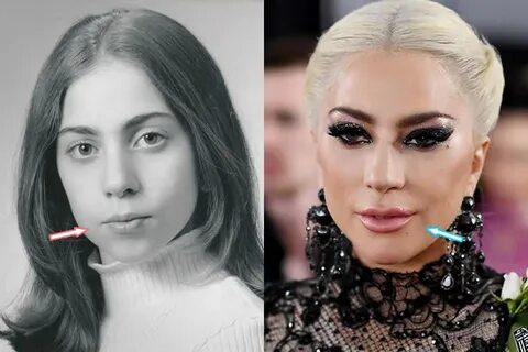 Lady Gaga Before Plastic Surgery