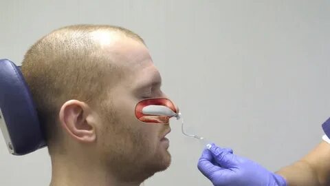 Nasal Packing for Nosebleed - YouTube