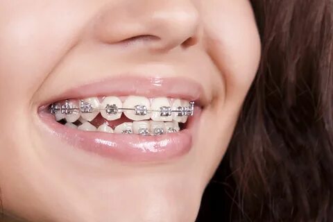 Dental braces Dental braces, Orthodontics, Teeth straighteni
