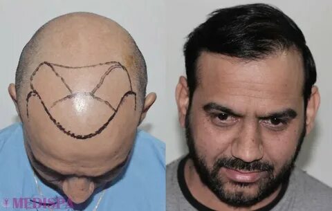 FUT Hair Transplant in Dubai. There are two scientifically p