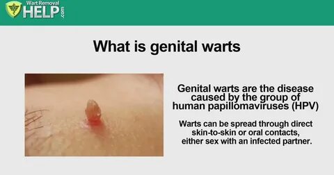 Wart Removal: Get Rid of Genital Warts Naturally, Fast and F