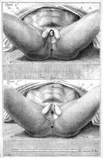 File:Hermaphrodite genitalia Wellcome L0022683.jpg - Wikimed