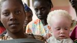 Afrique: "Les albinos sont considérés comme des êtres dotés 