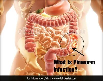 What is Pinworm Infection Causes Symptoms Treatment Risk Factors Diagnosis