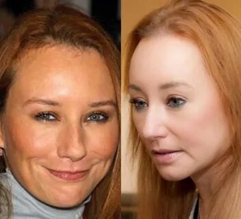 Tori Amos Plastic Surgery for unnatural looks!