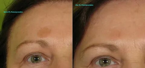 Ipl Pigment - Before & After Gallery - Live Young Medical