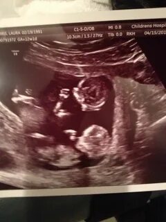 My ultrasound of twins at 12 weeks! Ultrassom, Dicas de grav