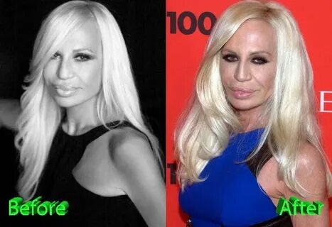 Donatella Versace Before and After Cosmetic Surgery Donatell