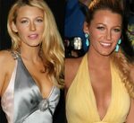Blake Lively Before And After Plastic Surgery