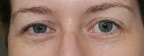 How to Fix Hooded Eyelids for Free Hooded eyelids, Face exer