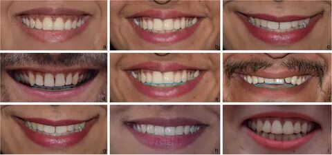 Analysis of different characteristics of smile BDJ Open