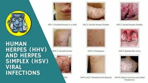 Human Herpes (HHV) and Herpes Simplex (HSV) Viral Infections