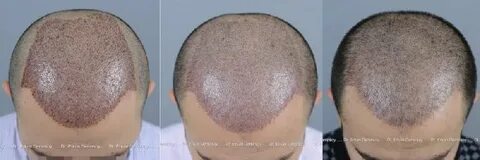 Hair Loss Forum