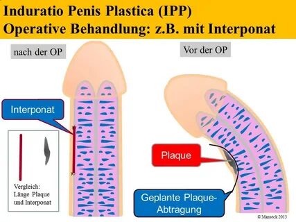 Penis trombose Pénis humano. 
