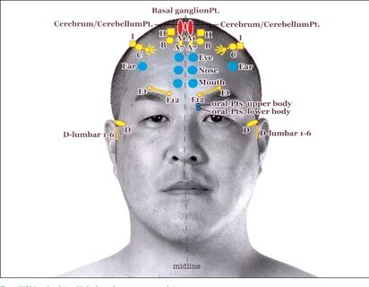 Figure 1 from Cortical Activation by Yamamoto New Scalp Acup
