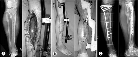 A) Tibial plateau fracture was stabilized with a knee-spanni