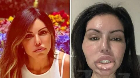 Liziane Gutierrez Suffers Face Swell After Another Botched P