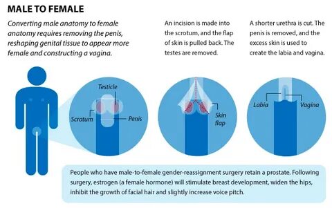 How Gender Reassignment Surgery Works