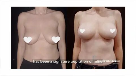 breast lift with implants, breast lift no implants, breast reduction, plast...