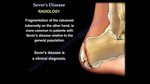 Sever's Disease - Everything You Need To Know - Dr. Nabil Eb