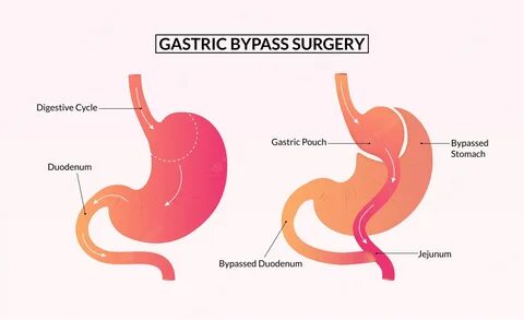Research about gastric bypass