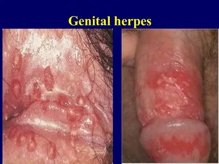 Genital Herpes &Genital Warts - ppt video online download
