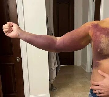 Cody Rhodes Posts An Updated Photo Of His Injury - WWF Old S