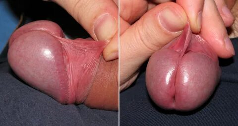 File:Frenulum of the penis.JPG - Wikimedia Commons