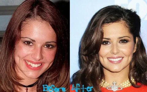 Cheryl Cole Plastic Surgery