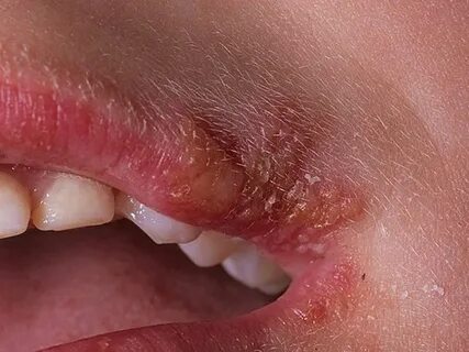 Herpes u ustima djeteta: glavni uzroci, preporuke za liječen