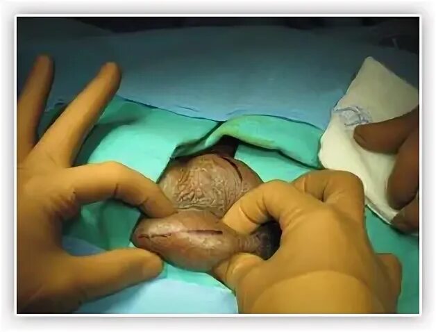 Vasectomy Reversal Procedure Images of a Reverse Vasectomy