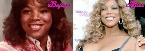 Wendy Williams SurgeryStars