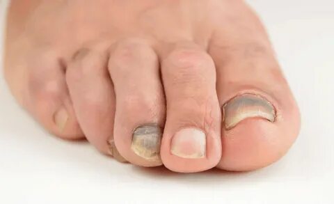 Suffering With Dark Spots Under Your Toenails? Treatments