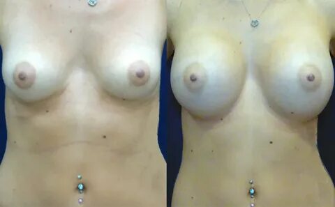 Before & After Breast aug 450 cc high profile via armpit inc
